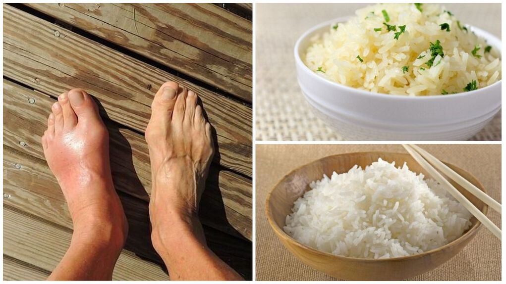 建议痛风患者以米饭为基础的饮食。